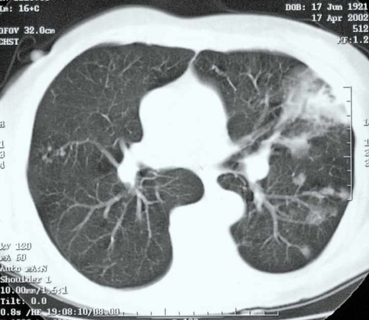 Hyperszenzitív pneumonia gyógyszerszedés kapcsán kialakult,