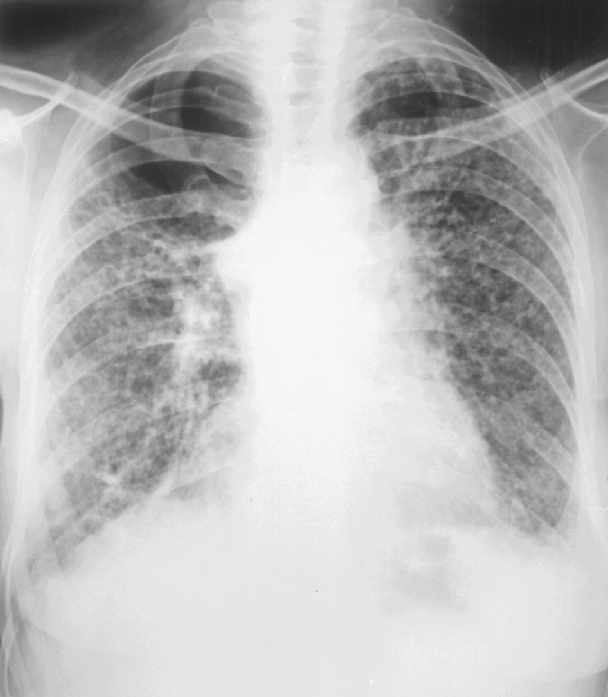 Tüdő fibrosis a kezeletlen vagy kezelhetetlen hiperszenzitív gyulladások