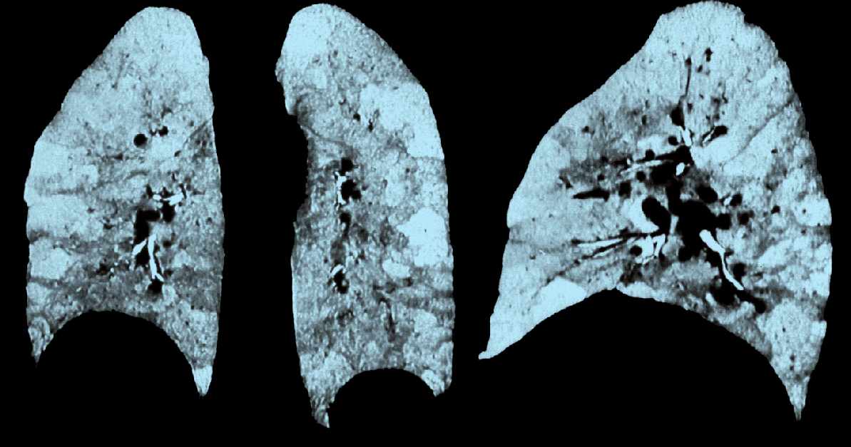 COPD* hosszantartó ingerlés, dohányzás hatására a bronchiolusok krónikus gyulladása, hegesedése következtében a