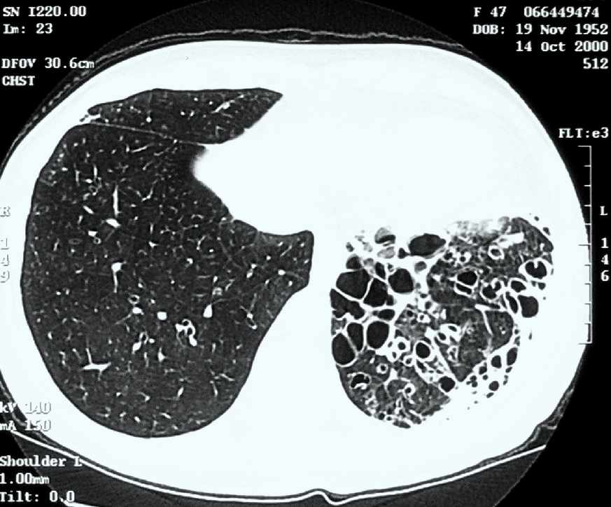 Bronchiectasia a CT-felvétel megvastagodott és kitágult