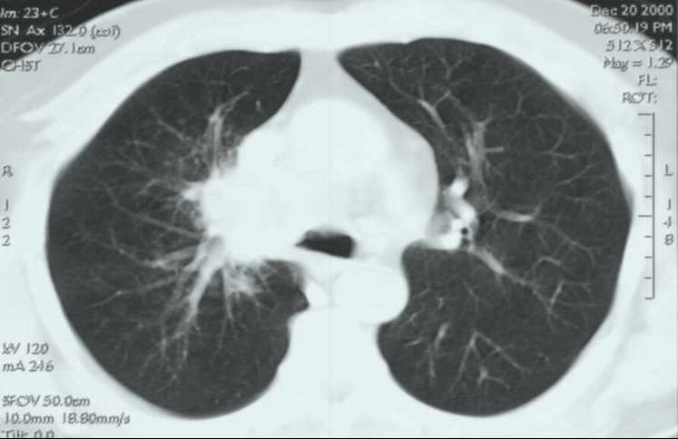 bronchus carcinoma seprűszerű nyúlványok,