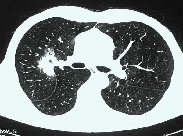 bronchus carcinoma a korai