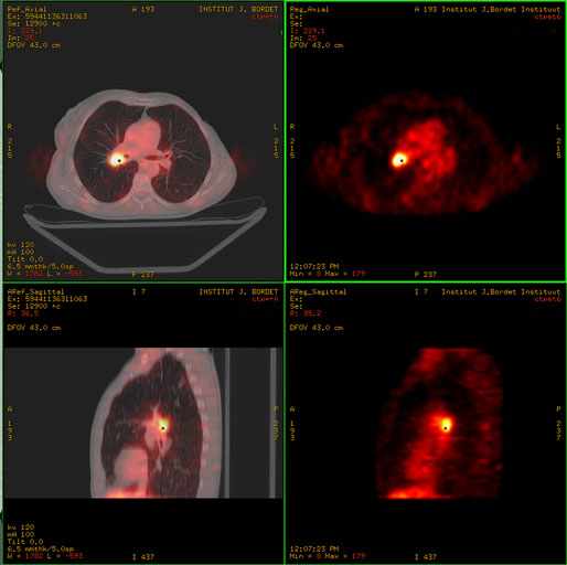 bronchus carcinoma a PET-CT a