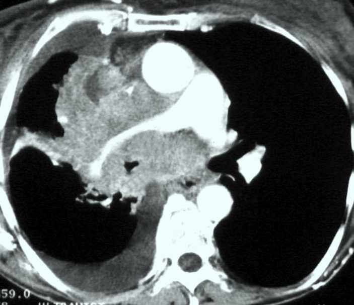 középső mediastinalis daganat artéria és