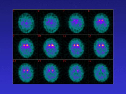 IN VIVO DIAGNOSZTIKA KÉPALKOTÁSSAL AGYI