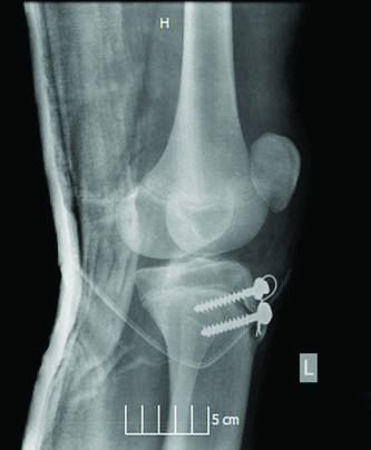 2. a ábra 2. b ábra 2. c ábra 2. d ábra 2. ábra Posztoperatív térdízületi röntgenfelvétel: csavaros húzóhurkos ostesynthesis, amely a törtdarabokat jó helyzetben rögzíti.