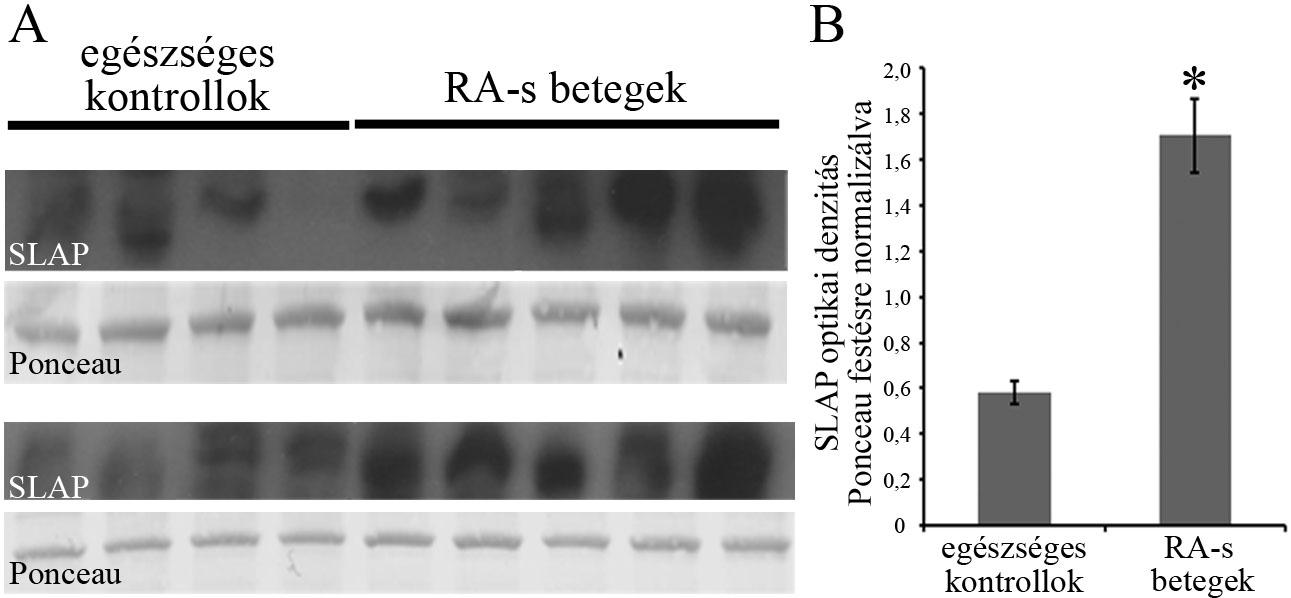 21. ábra: A SLAP szintje emelkedett RA-sok T-sejtjeiben.