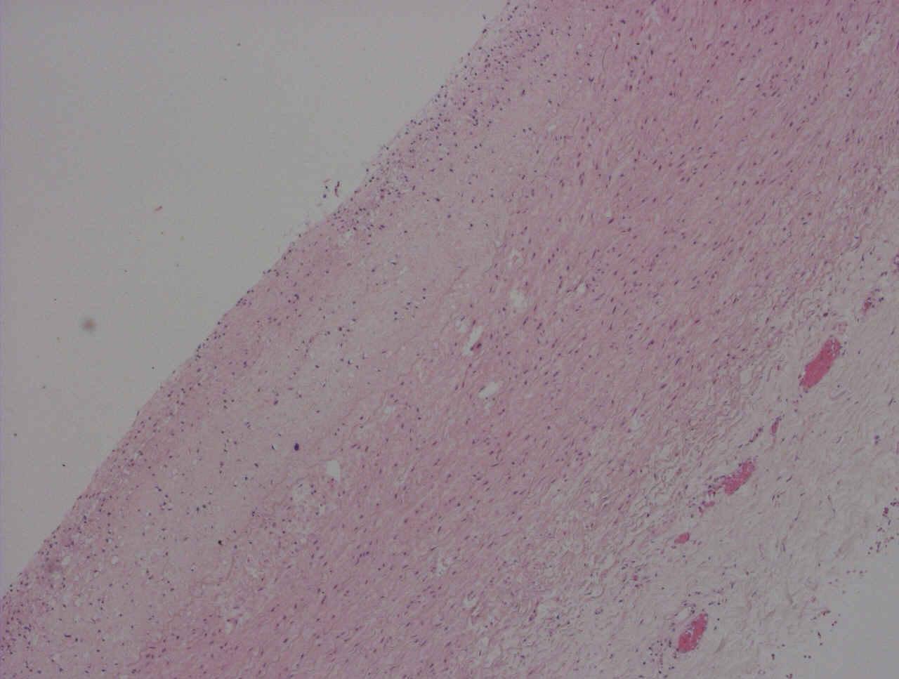 Az atherosclerosis kialakulásáról évről évre egyre többet tudunk, számos sejtszintű folyamatot (endothel sejtek szerepe, gyulladásos folyamatok, oxidatív stressz, oxidált LDL, HDL-koleszterin,
