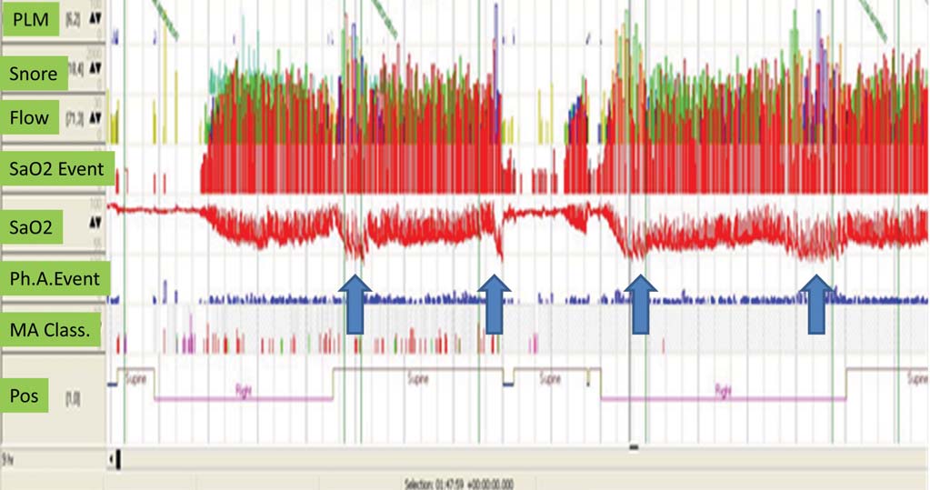 2. ábra Poliszomnogram, Alvás alatti hypoventilatio (Somnomedics, Németország; SE Pulmonológiai Klinika anyaga) A kép felső részén a teljes éjszakai vizsgálat adatain láthatóak az idő szakos, főként