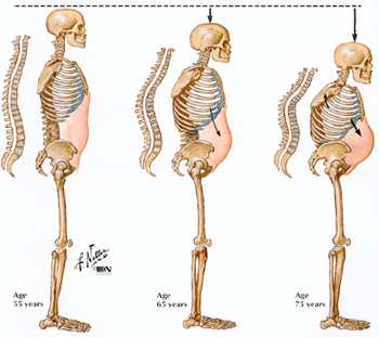 Jellegzetes klinikai kép Háti kyphosis fokozódik Lumbalis lordosis kiegyenesedik, majd kompenzatórikusan fokozódik a nyaki lordosis Medence hátrabillen