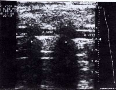 5 3. ábra Az artéria vertebralis 2D hosszmetszeti képe. A nyilak között a processus transversusok által árnyékolt szakasz Az esetek kb.