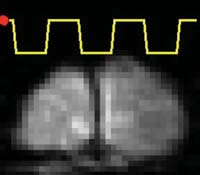 MRI: képi információ manipulálása I MRI: Non-invazív angiográfia Újraszeletelés merőleges síkban képszelet telített spinek véráram telítetlen spinek Térbeli projekció ( volume rendering ) MRI