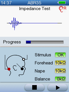 5 Tesztelés az AccuScreen -el Mindkét fül tesztelése Ha fülcsatlakoztatókkal végzi a tesztet, a Binaural (Binaurális) gomb jelenik meg. Nyomja meg ezt a gombot mindkét fül vizsgálatához. 5.4.