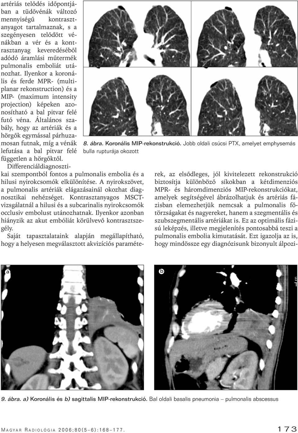 keveredéséôl dódó ármlási mûtermék pulmonlis emoliát utánozht.