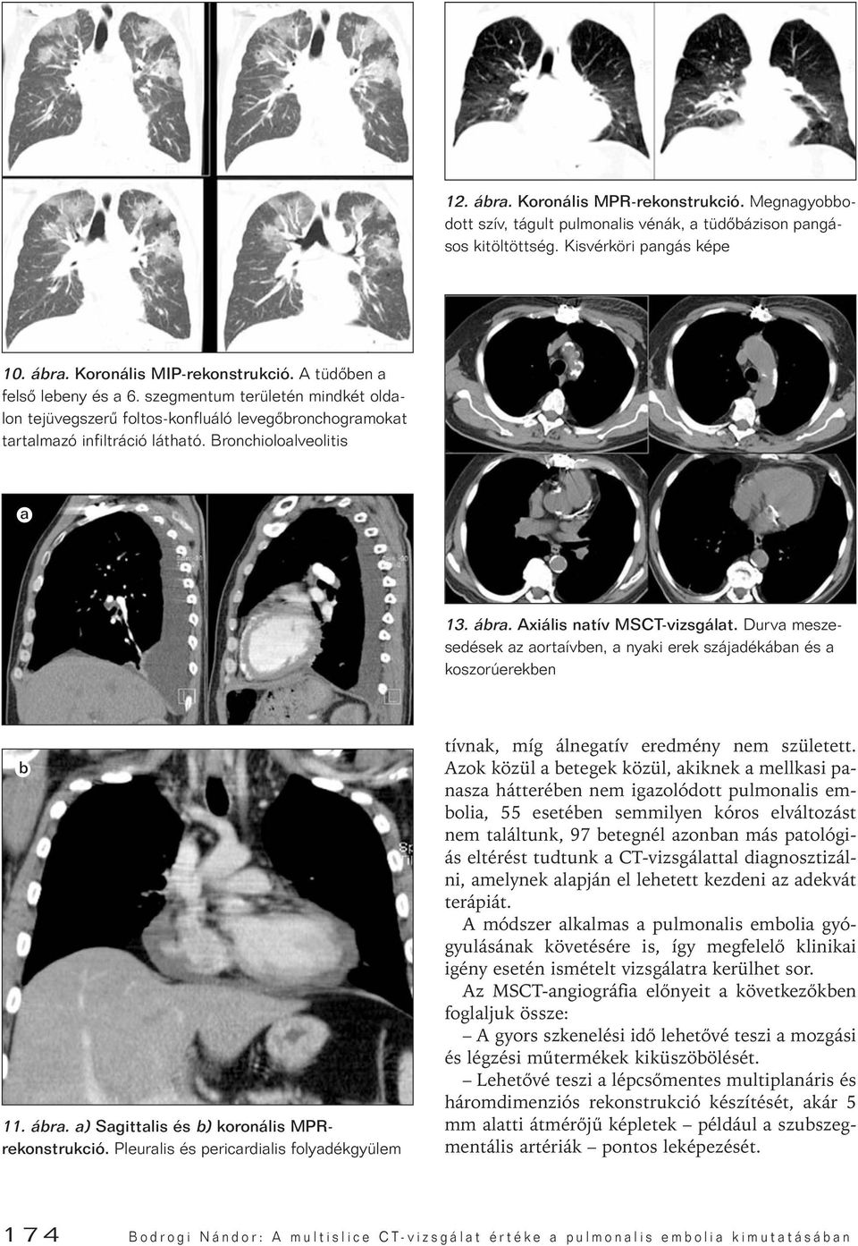 Durv meszesedések z ortíven, nyki erek szájdékán és koszorúereken 11. ár. ) Sgittlis és ) koronális MPRrekonstrukció. Pleurlis és pericrdilis folydékgyülem tívnk, míg álnegtív eredmény nem született.