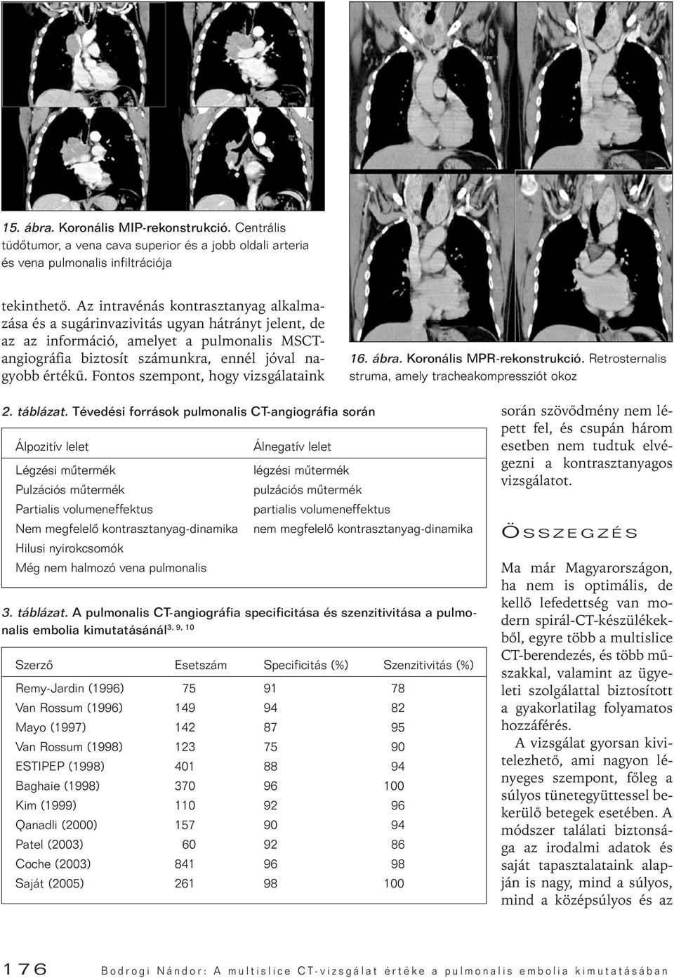 Fontos szempont, hogy vizsgáltink 16. ár. Koronális MPR-rekonstrukció. Retrosternlis strum, mely trchekompressziót okoz 2. tálázt.