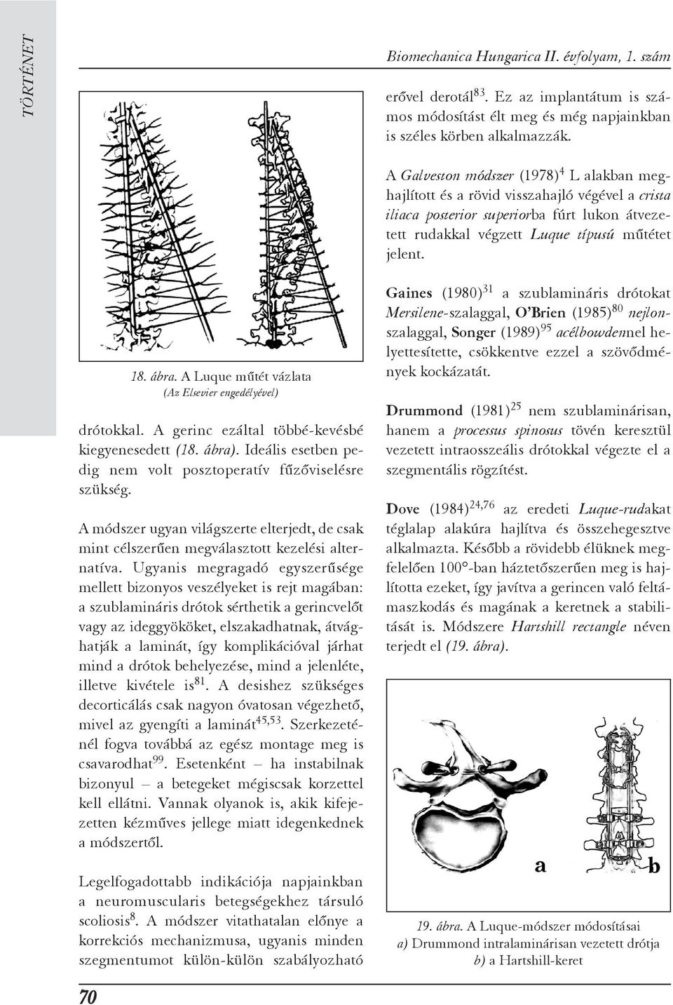 A Luque mûtét vázlata (Az Elsevier engedélyével) drótokkal. A gerinc ezáltal többé-kevésbé kiegyenesedett (18. ábra). Ideális esetben pedig nem volt posztoperatív fûzõviselésre szükség.