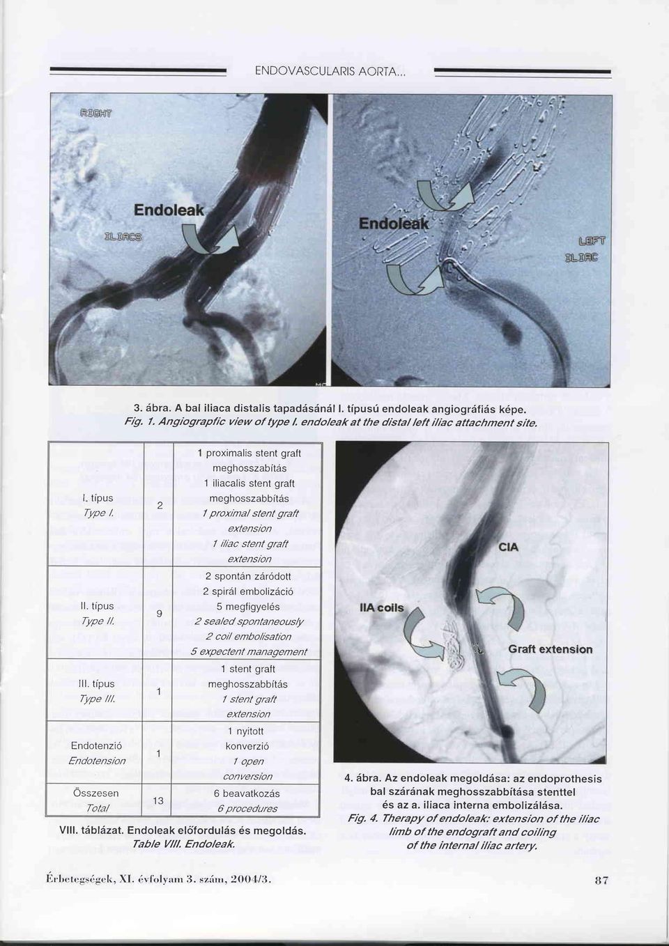 I 2 spiräl embolizäciö 5 megfigyeles 2 sea/ed spontaneous/y 2 coil embo/ßation 5 expectent management i ',L Graft extension lll. tipus Type ///.
