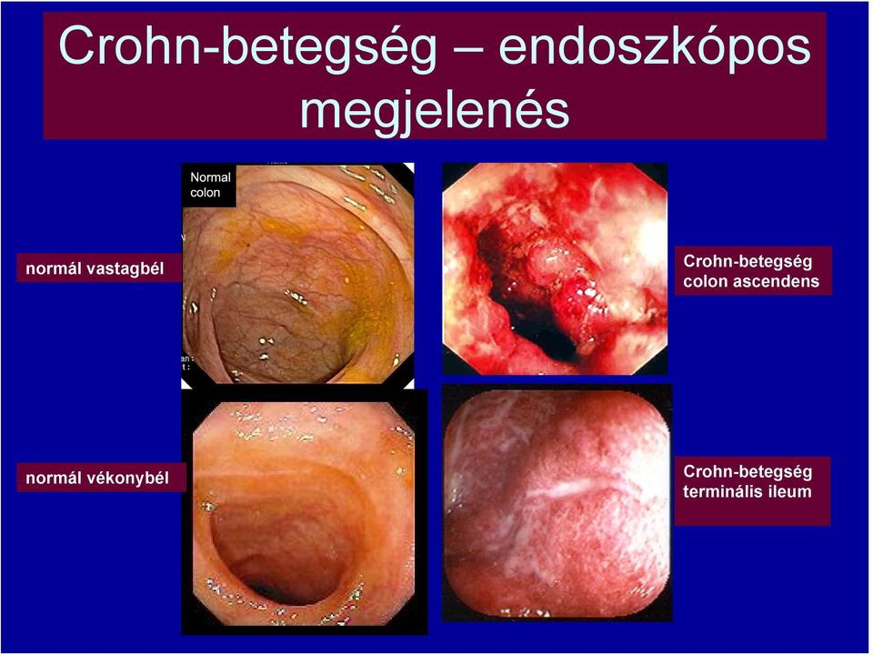 Crohn-betegség colon ascendens