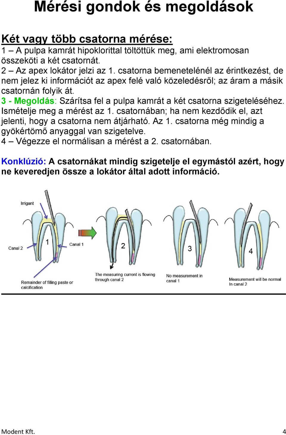 3 - Megoldás: Szárítsa fel a pulpa kamrát a két csatorna szigeteléséhez. Ismételje meg a mérést az 1. csatornában; ha nem kezdődik el, azt jelenti, hogy a csatorna nem átjárható. Az 1.