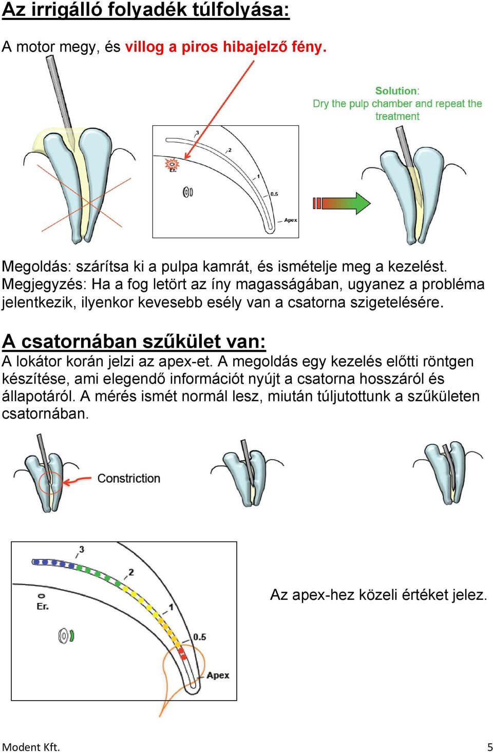 Megjegyzés: Ha a fog letört az íny magasságában, ugyanez a probléma jelentkezik, ilyenkor kevesebb esély van a csatorna szigetelésére.