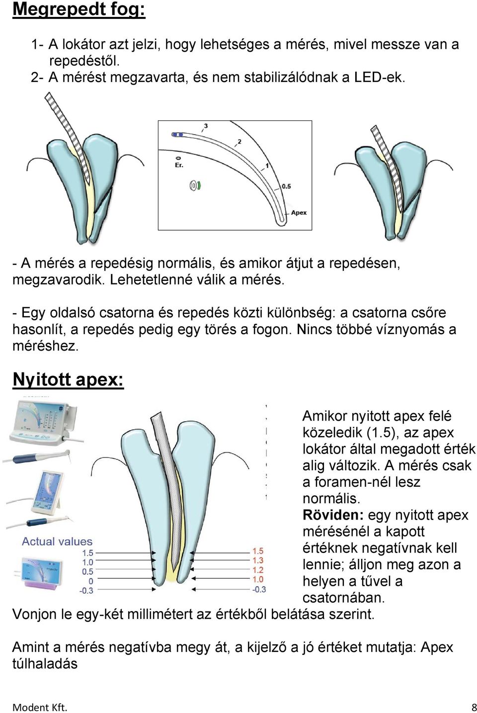 - Egy oldalsó csatorna és repedés közti különbség: a csatorna csőre hasonlít, a repedés pedig egy törés a fogon. Nincs többé víznyomás a méréshez. Nyitott apex: Amikor nyitott apex felé közeledik (1.