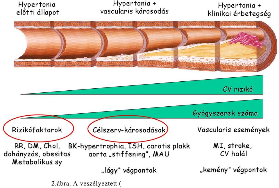 A veszélyeztett ( vulnerábilis ) páciens felismerése MI, stroke, CV halál kemény végpontok Az európai guideline-nal szemben sajnálatos módon a magyar ajánlásokba vagy bele sem került (pl. III.