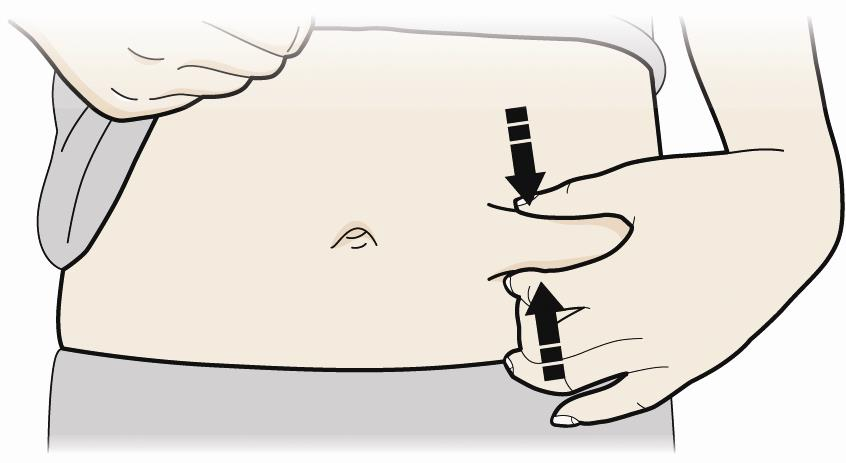 A 2. lépés: Készüljön fel Alaposan mosson kezet! Készítse elő és tisztítsa meg az injekció beadási helyét. Felkar Has A comb felső része Beadhatja az injekciót: Combja felső részébe.