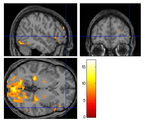 4. ábra Csoportanalízis eredményeként kapott agyi aktiváció az amygdala, az inzula (felső sor), a bazális ganglionok és az orbitofrontális kéreg (alsó sor) területén emocionális ingerek feldolgozása