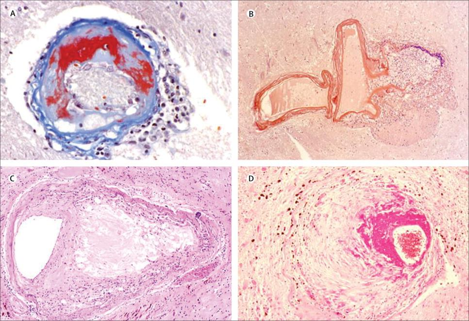 Lipohyalinosis Microaneurysm Microatheroma