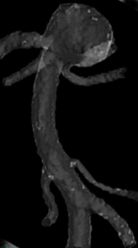 1. ábra: Ideális oldalfal aneurysma modell metszete (a: szül! ár átmér!, b: nyak átmér!, D: aneurysma átmér!, d: szül!ér tengely-aneurysma centrum távolság) 2.