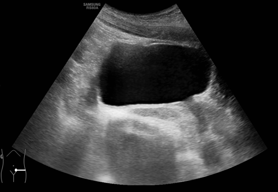 25. ábra. Hólyag és cervix transzverzális (horizontalis) síkú pásztázása. 26. ábra. Hólyag és cervix longitudinalis (sagittalis) síkú pásztázása. 27.