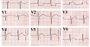 14. Példa determinisztikus jel EKG -