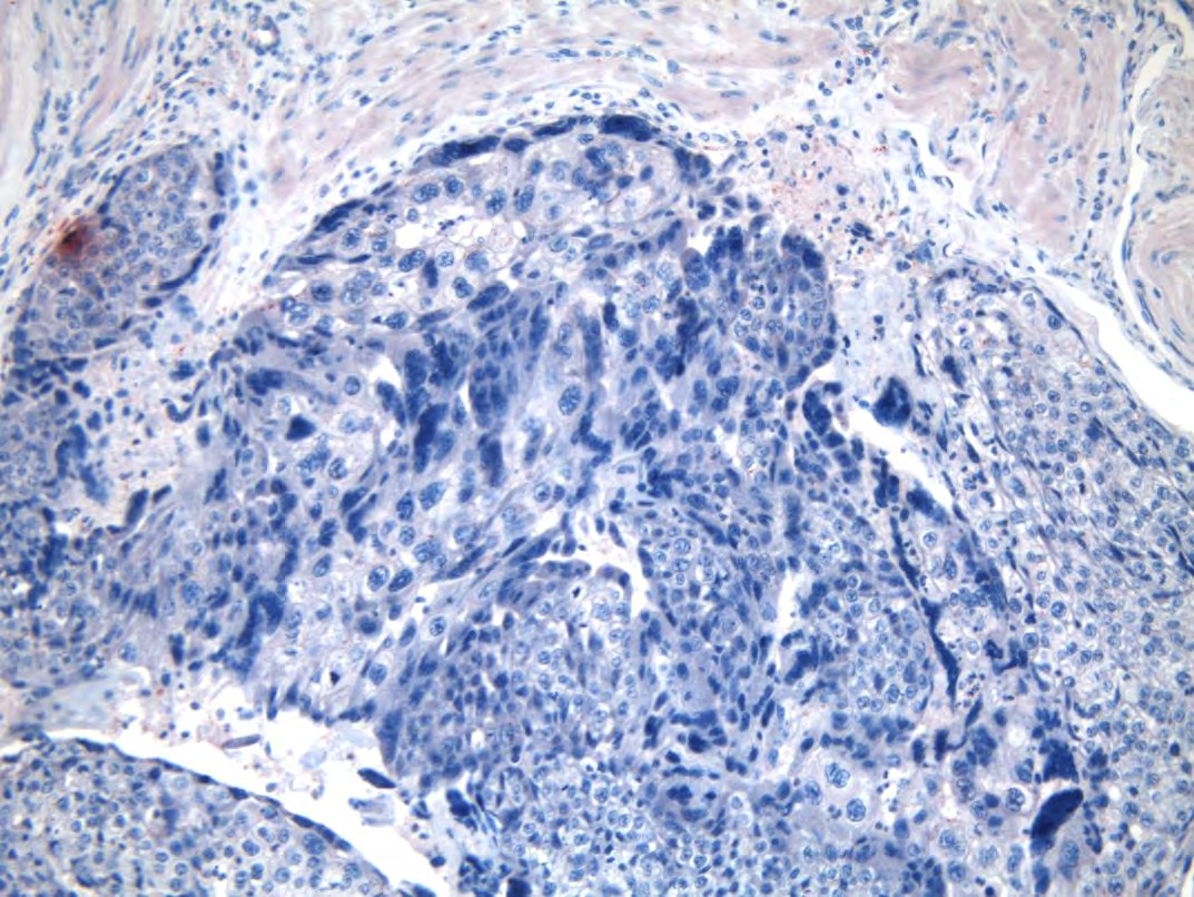 PIBF EXPRESSION IN A A: PARTIAL MOLE