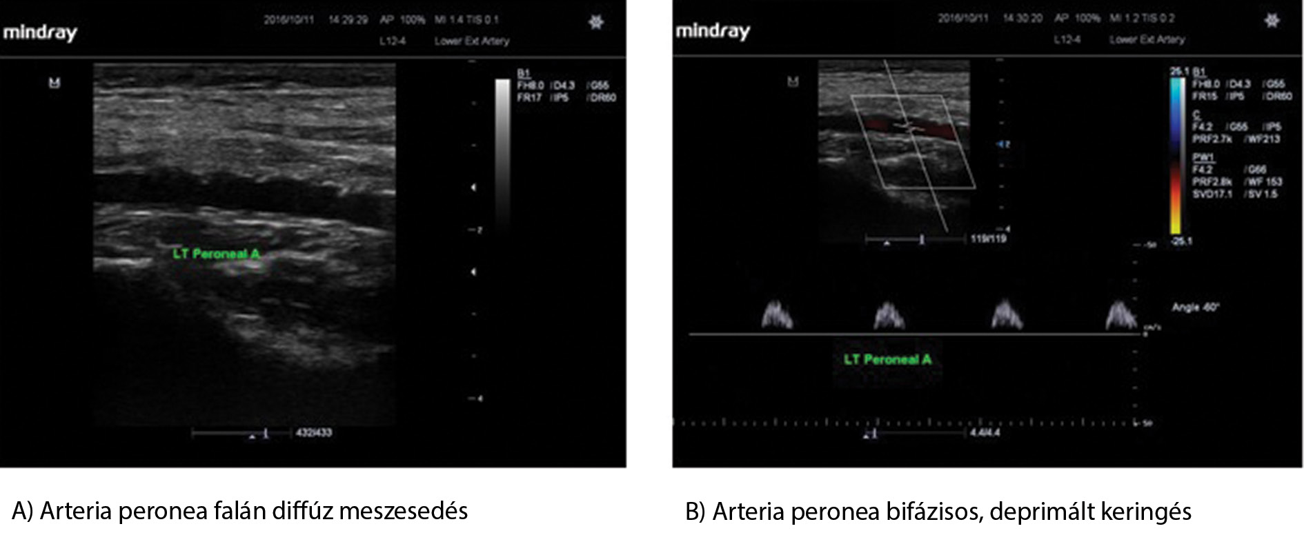 3. ábra Lábszári artériára (arteria peronea) lokalizálódó atherosclerosis color duplex ultrahangképe (Dr.