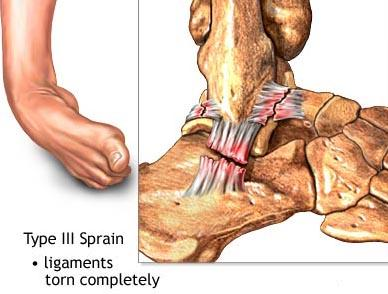 előfordulhat. A mechanizmus elsősorban supinatio, melyhez az esetek többségében többkevesebb plantar-flexio társul.