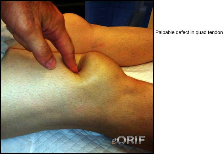 hirtelen extrém összehúzódás okozza főleg fáradt túlterhelt izomzat esetén. Többnyire részleges, leginkább a vastus medialis területén fordul elő. 009.