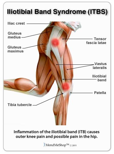 018.ábra Az ok lehet helytelen edzésmódszer, túlfejlett lateralis femur epicondylus, varus deformitás, végtaghossz különbség (minden olyan tényező, ami a külső oldalon a varus irányú terhelést