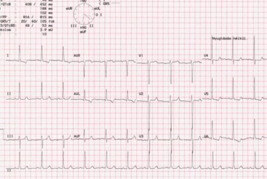 2. Ábra 13 éves leány kóros EKG-ja Súlyos aorta stenosis következtében kialakuló balkamra hypertrophia A V5 és V6-ban negatív T hullámok láthatók, balkamrai strain (feszülés) jele.