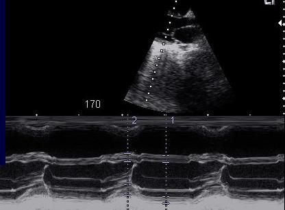5. Ábra 13 éves leány normális echocardiographiás felvétele Pánikbetegség okozta mellkasi fájdalom: normális nagyságú szívüregek, jó kontraktilitás, organikus szívbetegség nem igazolható 6.