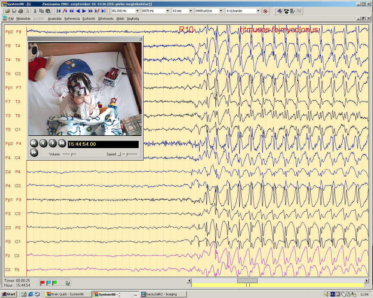 Videó-EEG