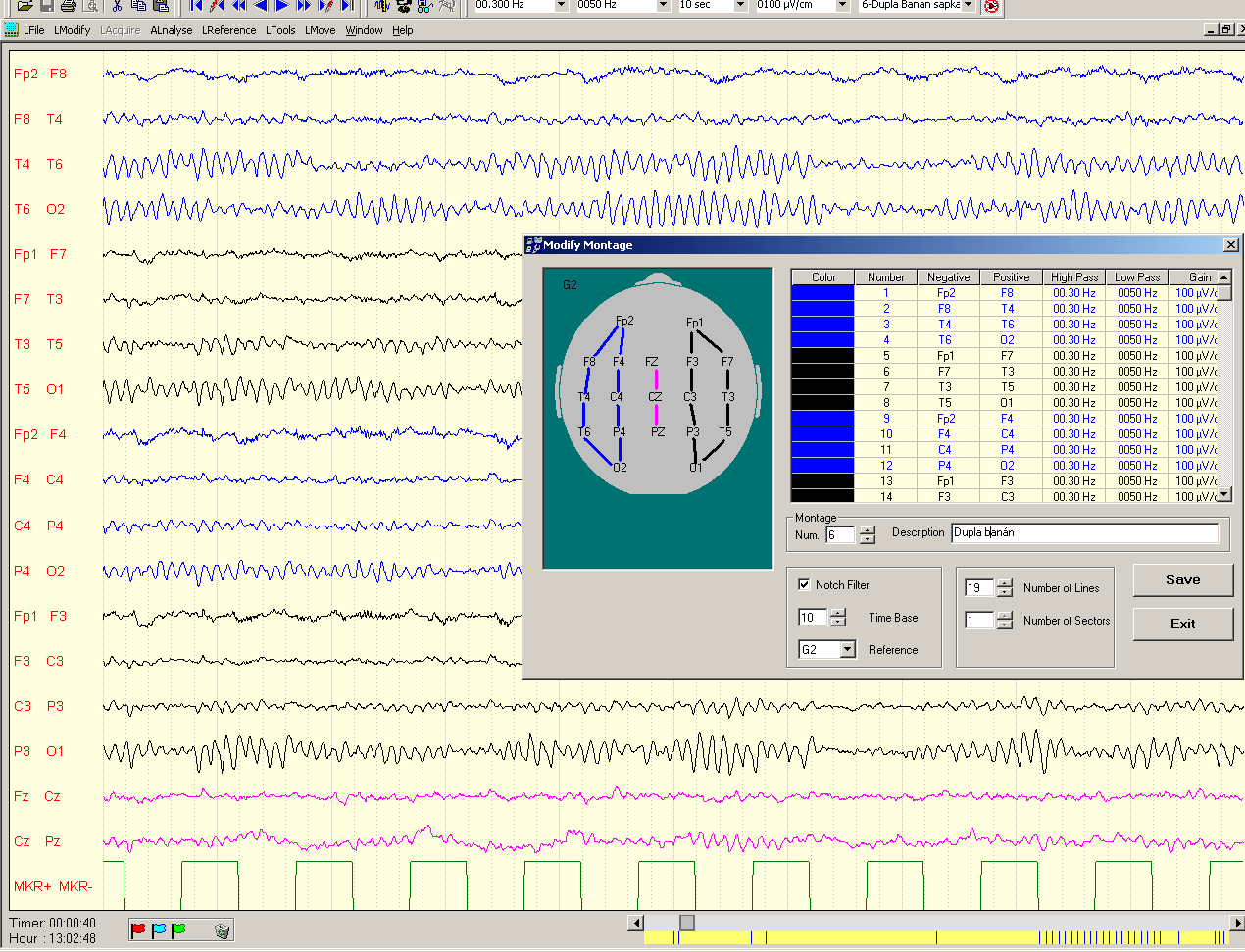 Epilepszia diagnosztika elemei EEG