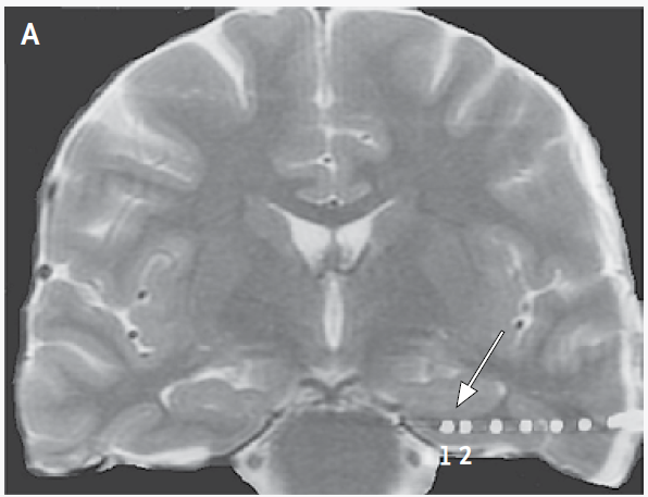 A humán entorhinalis cortex idegsebészeti beavatkozás alatti ingerlése javítja a térbeli tanulást és módosítja a hippocampus elektromos aktivitását Feladat: útvonal