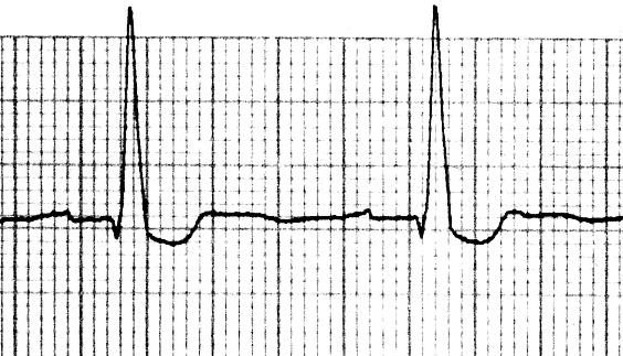 GYÓGYSZERMÉRGEZÉSEK 10 Tüneti: - Görcsrohamra: diazepam vagy phenobarbital vagy thiopental anesthesia - Tachycardia, aritmia esetén: -blokkoló (propranolol, vagy esmolol infúzió) - Hányásra: