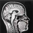 MRI képalkotás I: Térbeli felbontás NMR jel térbeli kódolása: a precessziós frekvencia mágneses térfüggésére épül voxel: térfogatelem pixel: felületelem, elemi képpont Kép B z Elemi 3D képpontok