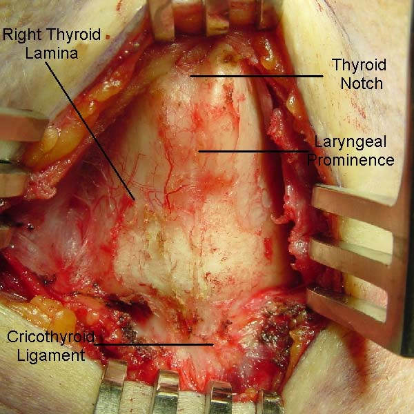 Percutaneous tracheostomy - a new method. Schachner A, Ovil Y, Sidi J, et al. Crit Care Med 1989; Oct; 17(10): 1052-6.
