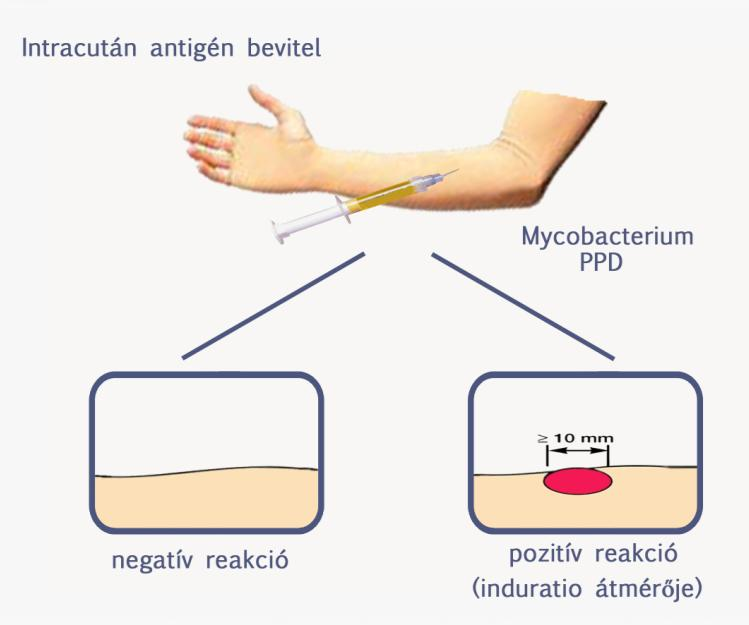 A vizsgálat során a bőrbe (intracutan) juttatnak injekciós tűvel egy speciális, a tuberkulózist okozó Mycobacter tuberculosis (TBC) baktériumból készített, nem kórokozó kivonatot.