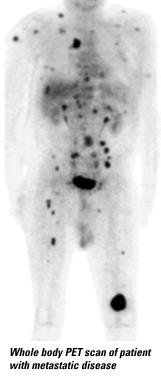 This imag shows a brain tumor.