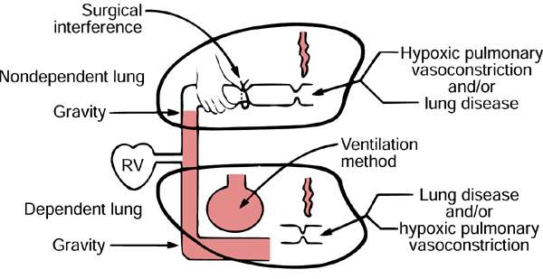 LÉPÉSEK HYPOXIA ELKERÜLÉSÉRE Közepes PEEP beállítása FiO 2 emelése Megfelelő V T normokapnia biztosítására.