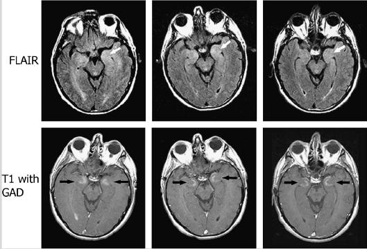 Antitest-mediált limbikus encephalitis Acut-subacut kezdetű amnézia,